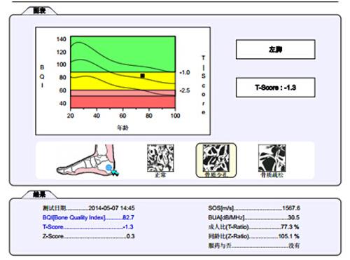 骨密度測(cè)量結(jié)果.jpg